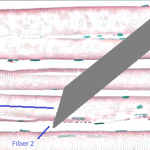 Η βελόνα του ηλεκτρομυογραφήματος καταγράφει δύο γειτονικές μονήρεις μυϊκές ίνες